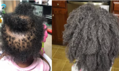 8 Natural Remedies To Combating Hair Loss in Black Kids